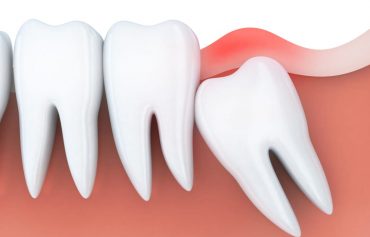 Tooth Extraction and Embedded Tooth Extraction
