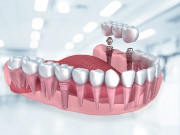 Dental Implant Applications