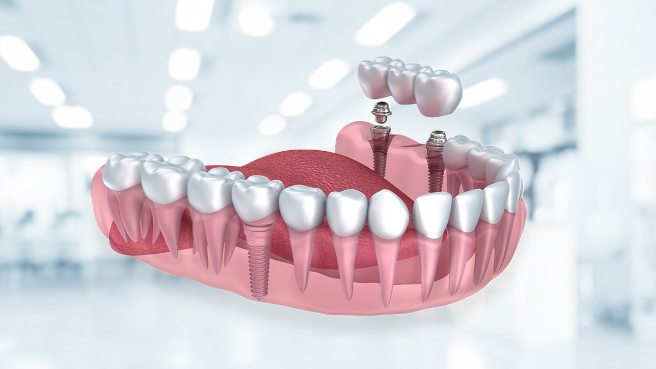 diş implant ile ilgili görsel sonucu